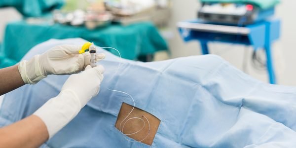 Epidural Doğum Nedir Nasıl Yapılır?